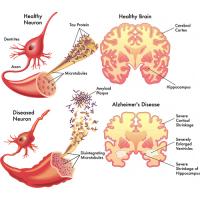 Alzheimer's disease